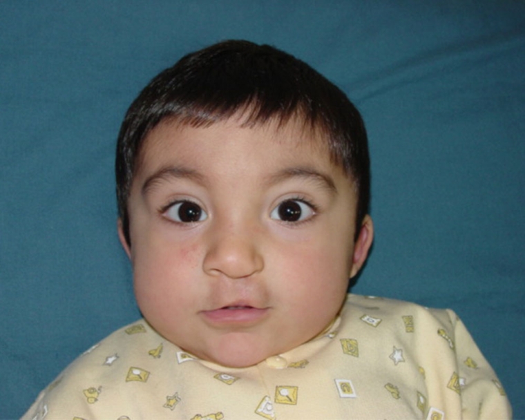 Vicente after cleft plate surgery