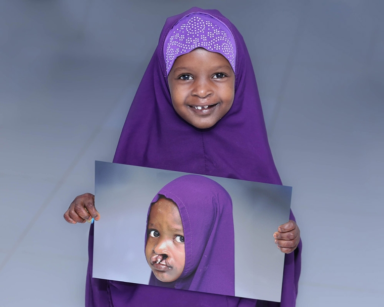 child holds the image of herself before cleft lip surgery