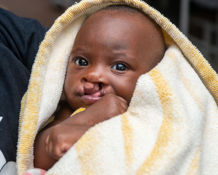 A Tanzanian baby before cleft surgery