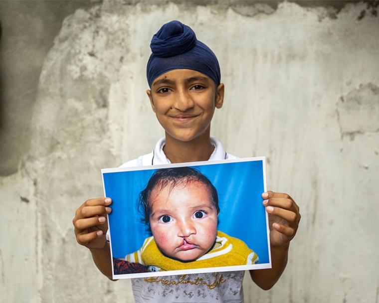 Anmolpreet smiling and holding a picture of himself before cleft surgery