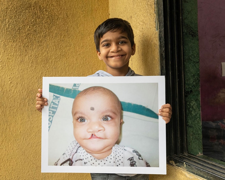Samrat smiling and holding a picture of himself before cleft surgery