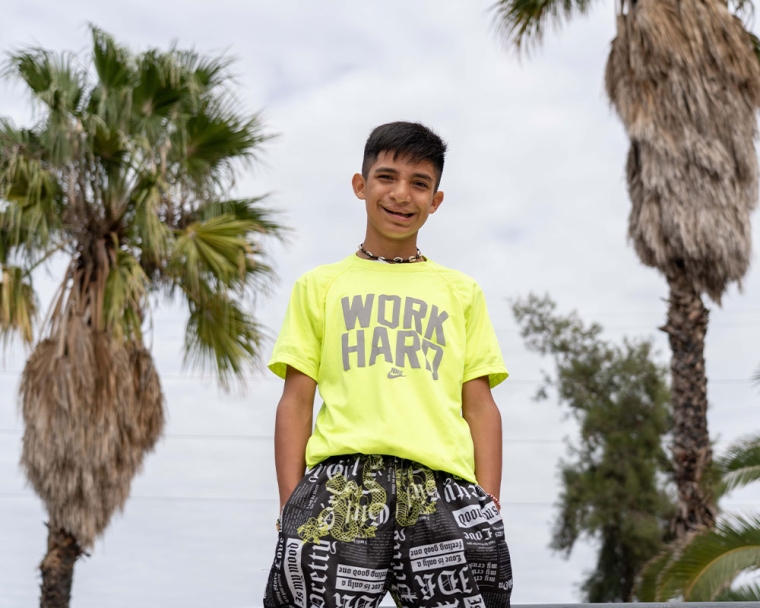 Bautista standing and smiling after his cleft surgery