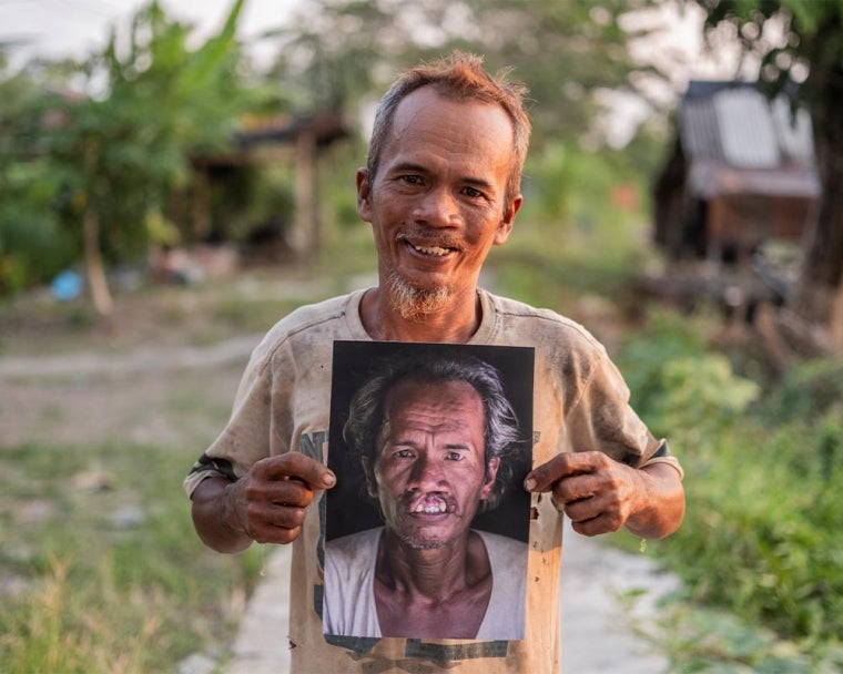 Alim smiling and holding a picture of himself before cleft surgery
